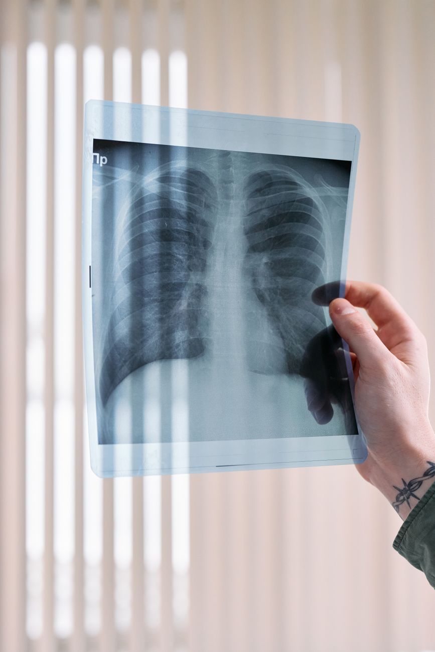Switching from cigs to ecigs does not significantly reduce lung cancer&nbsp;risk